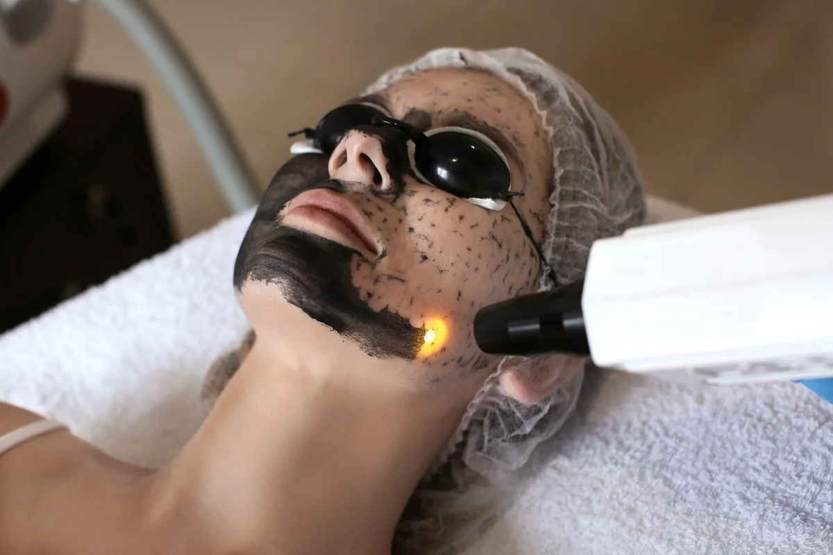 Carbon Peel (Hollywood Peel)